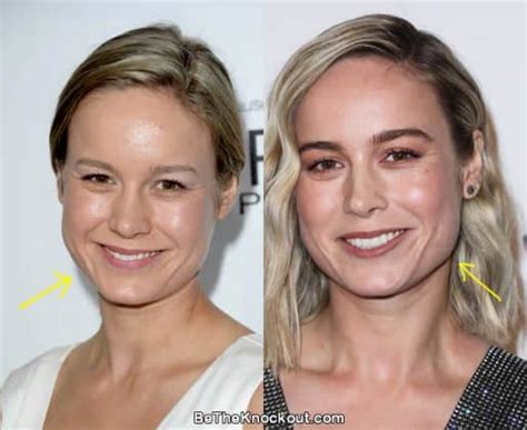 Brie Larson Plastic Surgery Comparison Photos